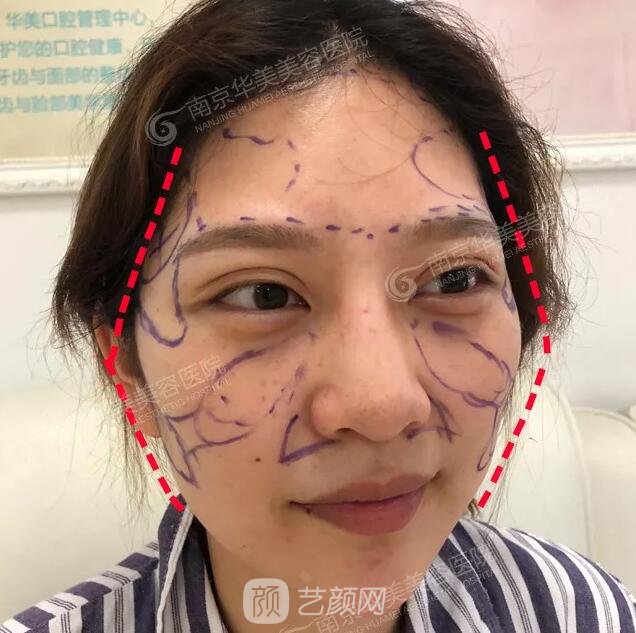 南京華美裴旭芳怎么樣?自體脂肪填充全臉真人案例