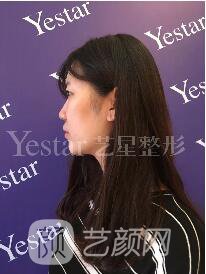 南京藝星割雙眼皮案例半年圖