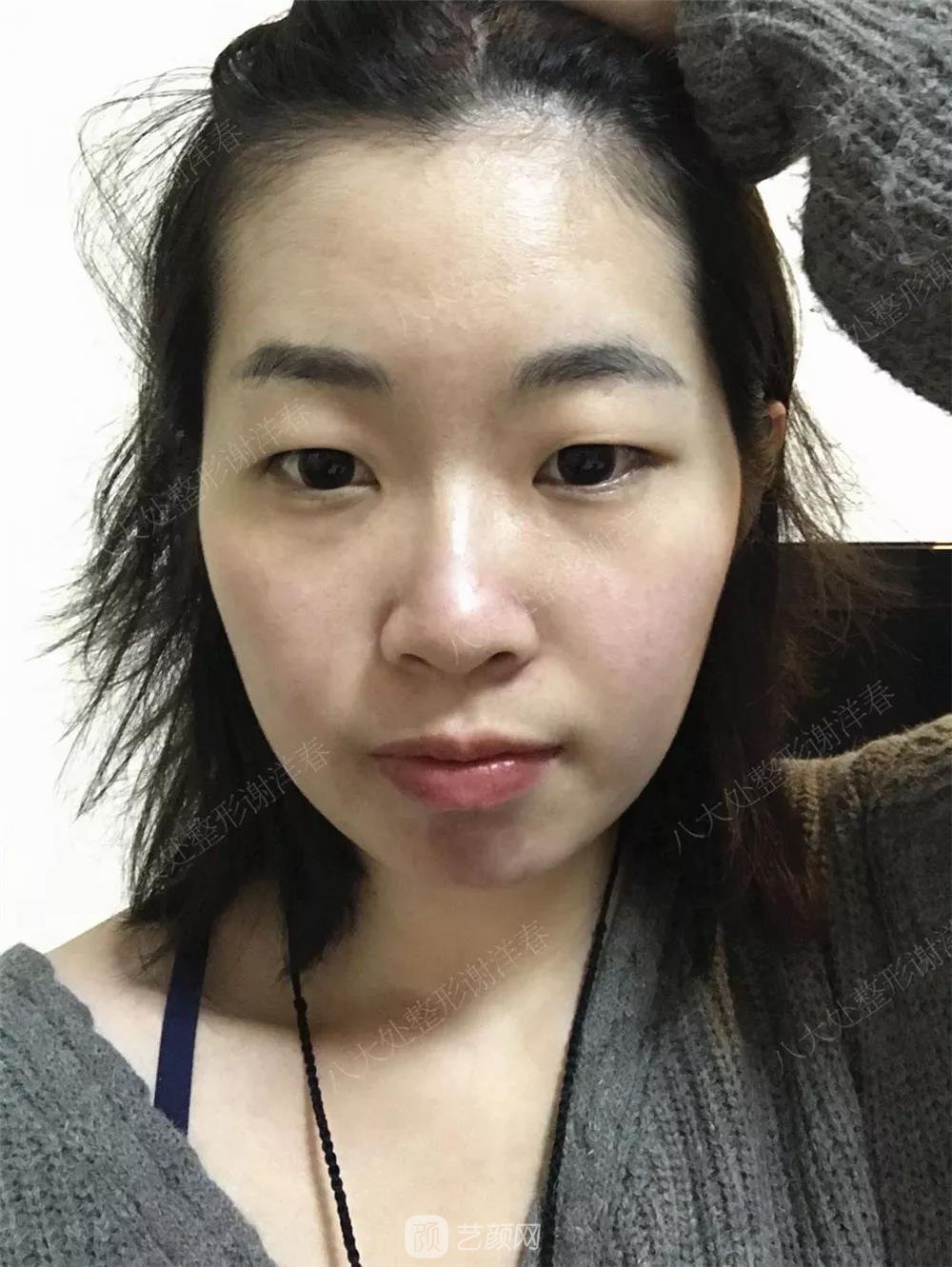 北京八大處割雙眼皮恢復(fù)過(guò)程，內(nèi)附圖