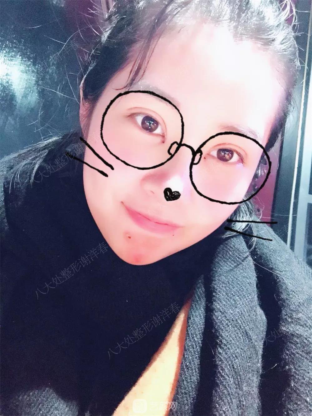 北京八大處割雙眼皮恢復(fù)過(guò)程，內(nèi)附圖