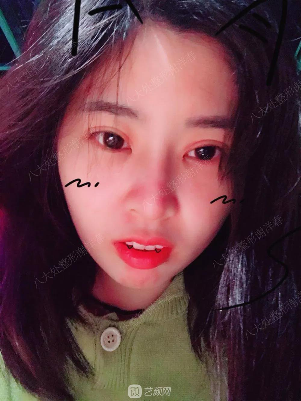 北京八大處割雙眼皮恢復(fù)過(guò)程，內(nèi)附圖