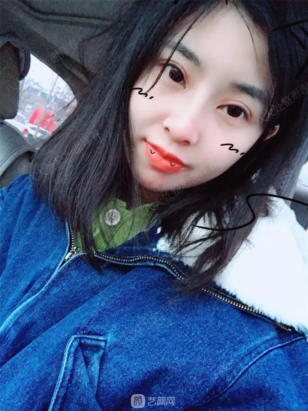 北京八大處割雙眼皮恢復(fù)過(guò)程，內(nèi)附圖