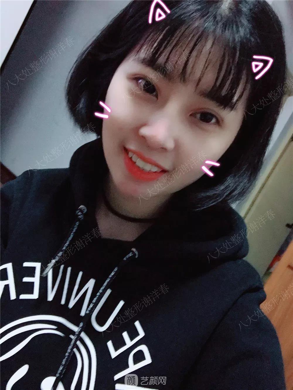 北京八大處割雙眼皮恢復(fù)過(guò)程，內(nèi)附圖