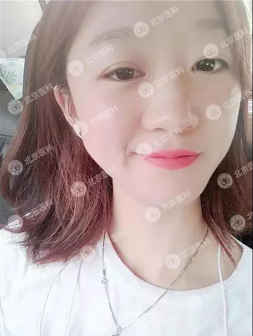 北京八大處整形布仁全切雙眼皮真實(shí)案例|圖