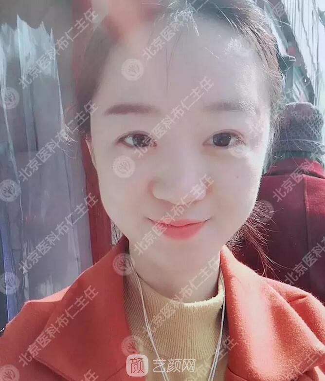 北京八大處整形布仁全切雙眼皮真實(shí)案例|圖