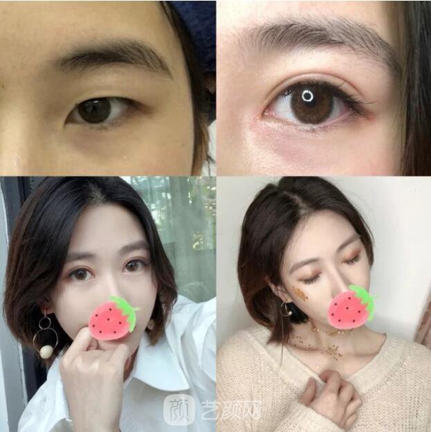 東莞美立方單眼皮割雙眼皮圖|內(nèi)附手術(shù)全程恢復(fù)
