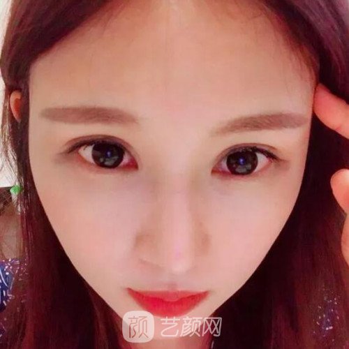 成都銅雀臺(tái)雷剛雙眼皮修復(fù)案例分享，半個(gè)月果圖~