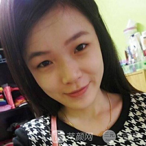 上海華美楊亞益主任做的芭比雙眼皮，果很好哦~