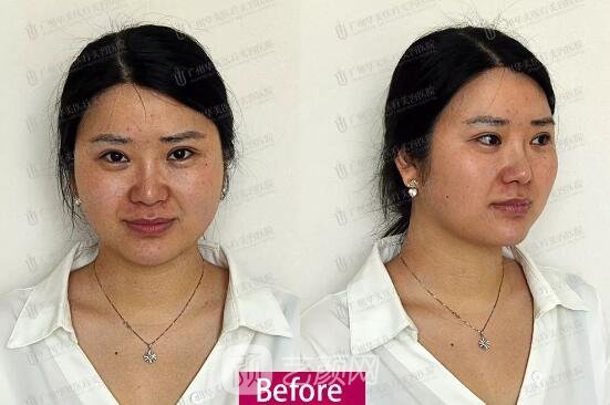 皮-秒激光祛斑案例，恢復(fù)照片分享~