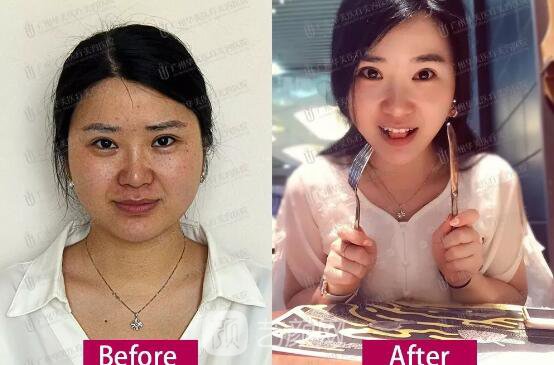 皮-秒激光祛斑案例，恢復(fù)照片分享~