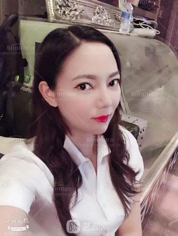 上海喜美全肋鼻修復+鼻頭縮小+鼻小柱后縮矯正案例~