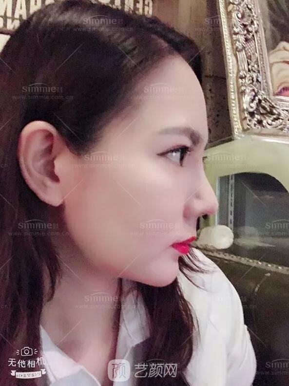 上海喜美全肋鼻修復+鼻頭縮小+鼻小柱后縮矯正案例~