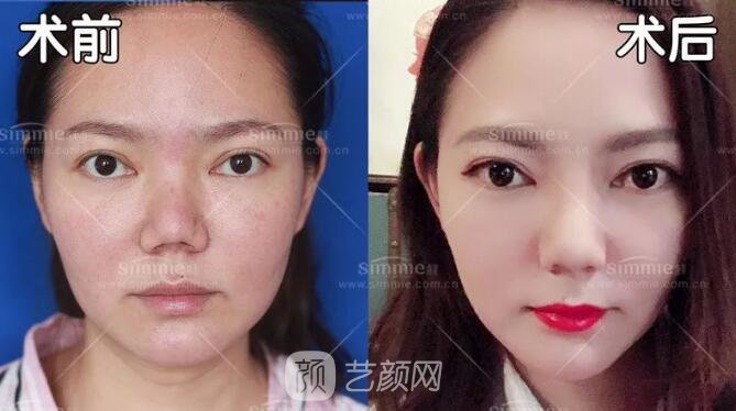 上海喜美全肋鼻修復+鼻頭縮小+鼻小柱后縮矯正案例~
