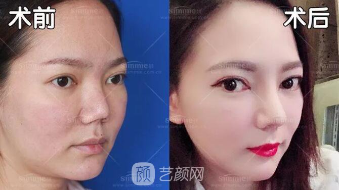 上海喜美全肋鼻修復+鼻頭縮小+鼻小柱后縮矯正案例~