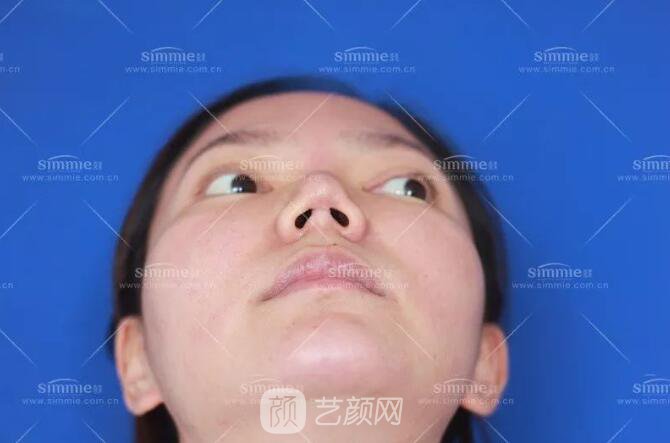 上海喜美全肋鼻修復+鼻頭縮小+鼻小柱后縮矯正案例~
