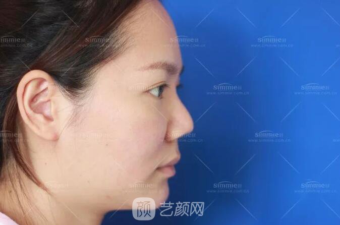 上海喜美全肋鼻修復+鼻頭縮小+鼻小柱后縮矯正案例~