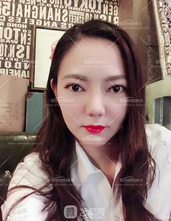 上海喜美全肋鼻修復+鼻頭縮小+鼻小柱后縮矯正案例~