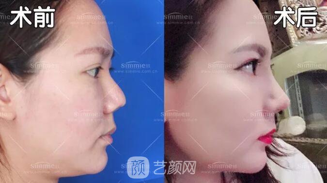 上海喜美全肋鼻修復+鼻頭縮小+鼻小柱后縮矯正案例~