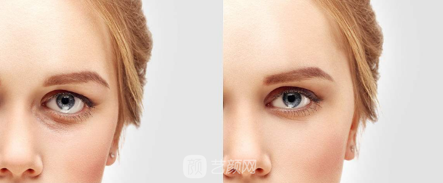 激光祛眼袋價格貴嗎？大概需要多少錢？