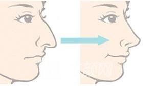 鷹鉤鼻矯正術(shù)