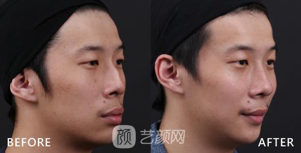武漢駝峰鼻矯正費(fèi)用大概多少？