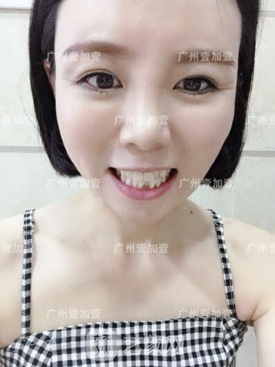 真實(shí)齙牙矯正牙齒案例