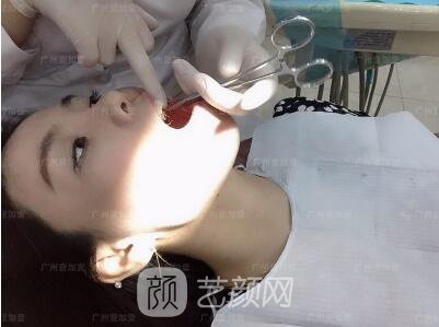 真實(shí)齙牙矯正牙齒案例