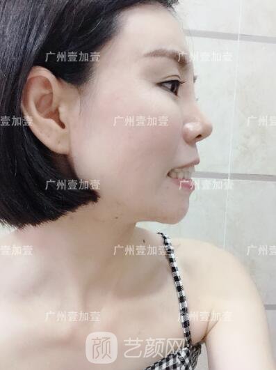 真實(shí)齙牙矯正牙齒案例