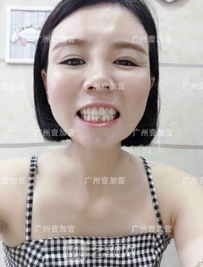 真實(shí)齙牙矯正牙齒案例