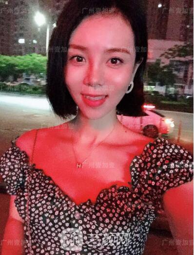 真實(shí)齙牙矯正牙齒案例