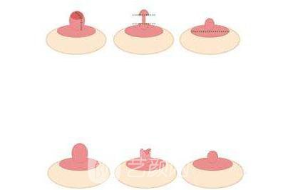 乳頭內(nèi)陷矯正