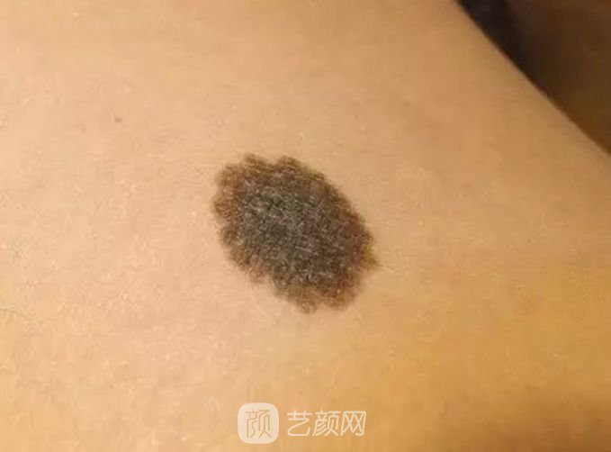 北京激光去痦子多少錢(qián)？