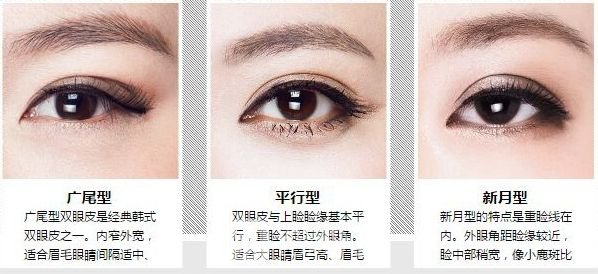 　蘇州內(nèi)雙割雙眼皮多少錢