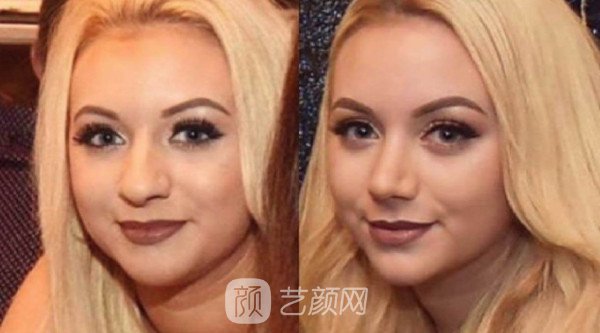 北京自體肋軟骨隆鼻費用是多少