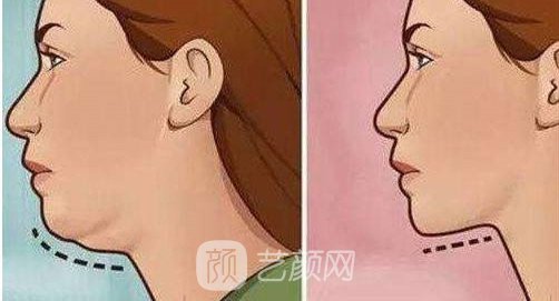 深圳磨尖下巴骨多少錢？