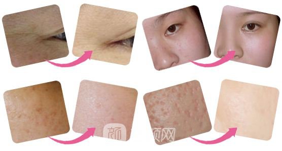 唐山做全身光子嫩膚價格大概多少錢？