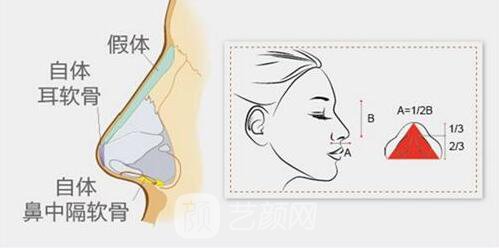 上海耳軟骨墊鼻尖多少錢?