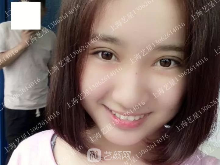 上海藝星割雙眼皮術(shù)后一個(gè)月恢復(fù)日記一則~