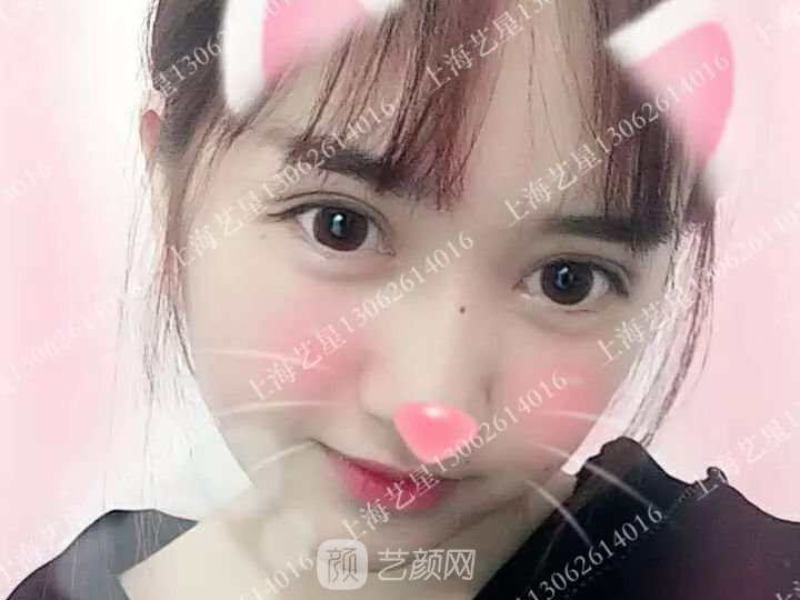 上海藝星割雙眼皮術(shù)后一個(gè)月恢復(fù)日記一則~