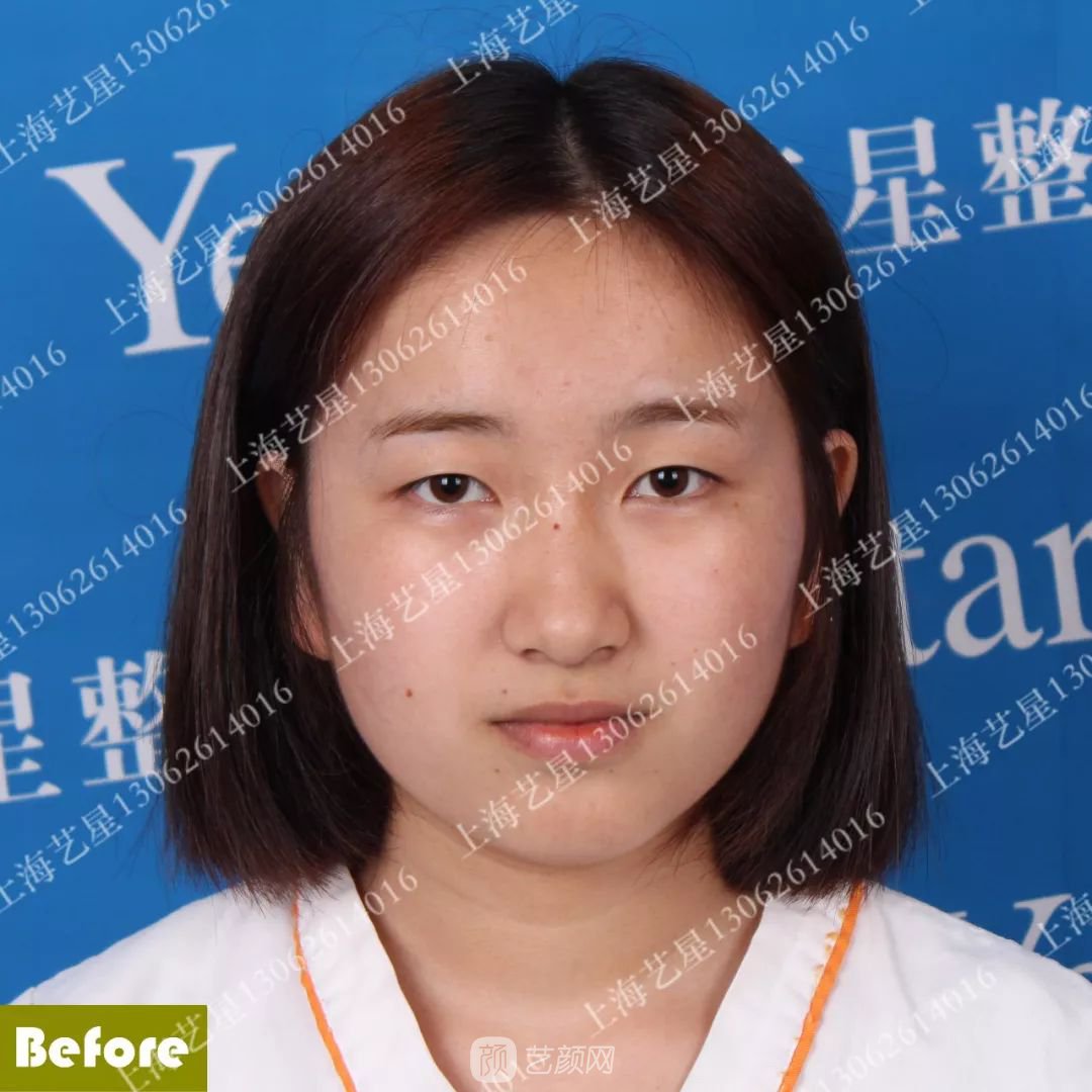 上海藝星割雙眼皮術(shù)后一個(gè)月恢復(fù)日記一則~