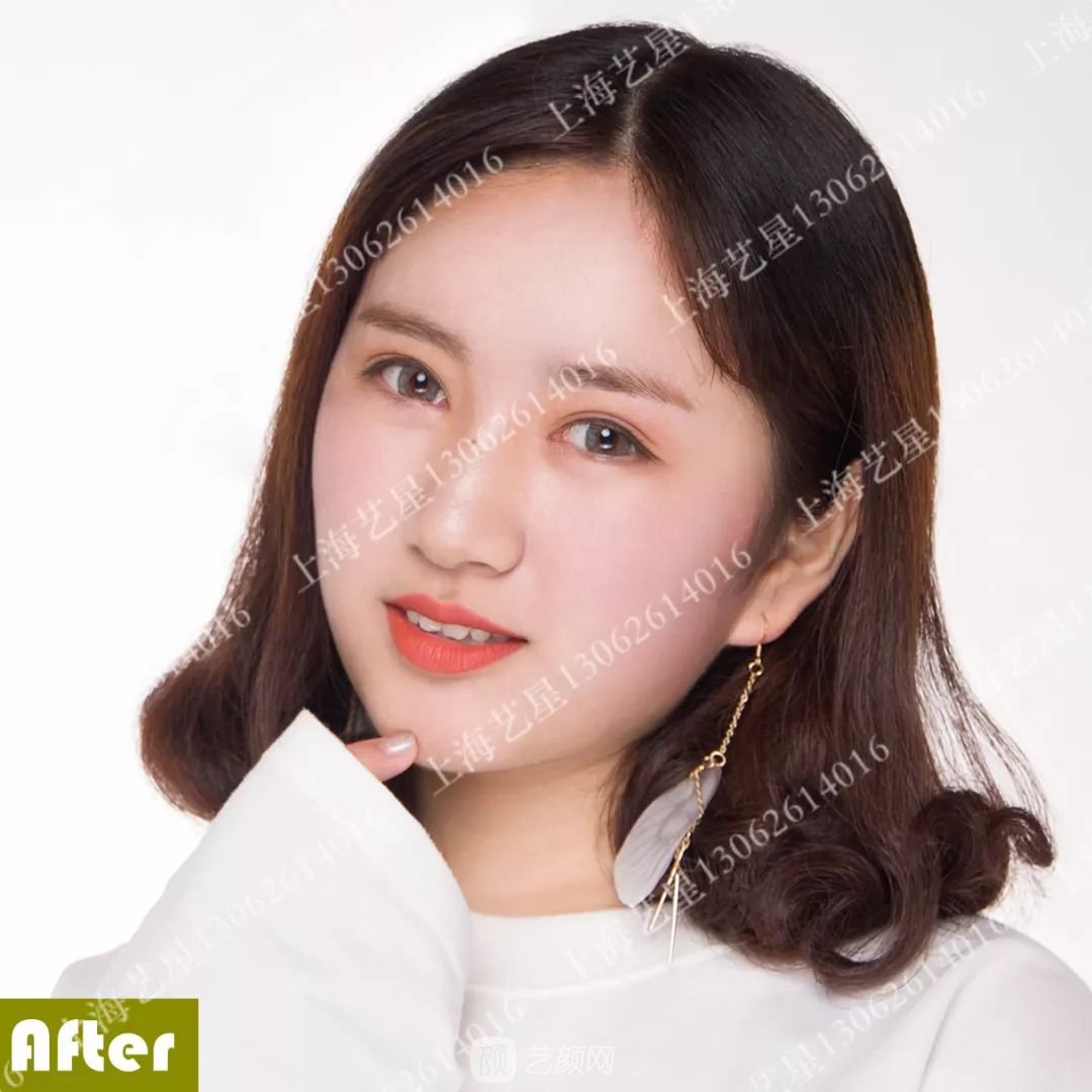 上海藝星割雙眼皮術(shù)后一個(gè)月恢復(fù)日記一則~