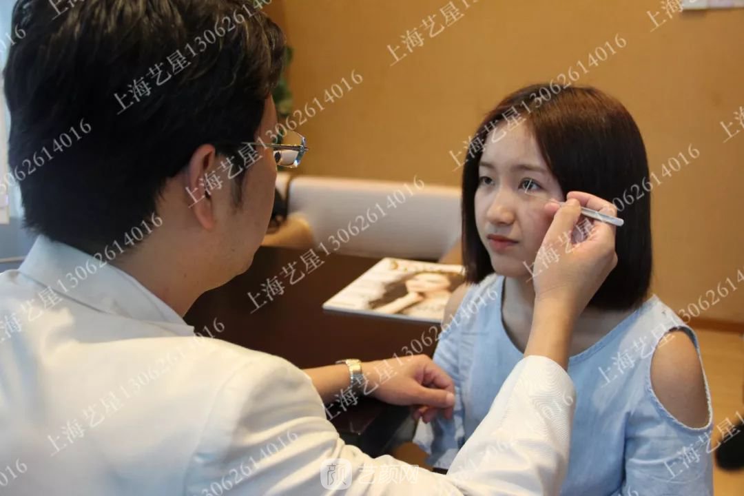 上海藝星割雙眼皮術(shù)后一個(gè)月恢復(fù)日記一則~