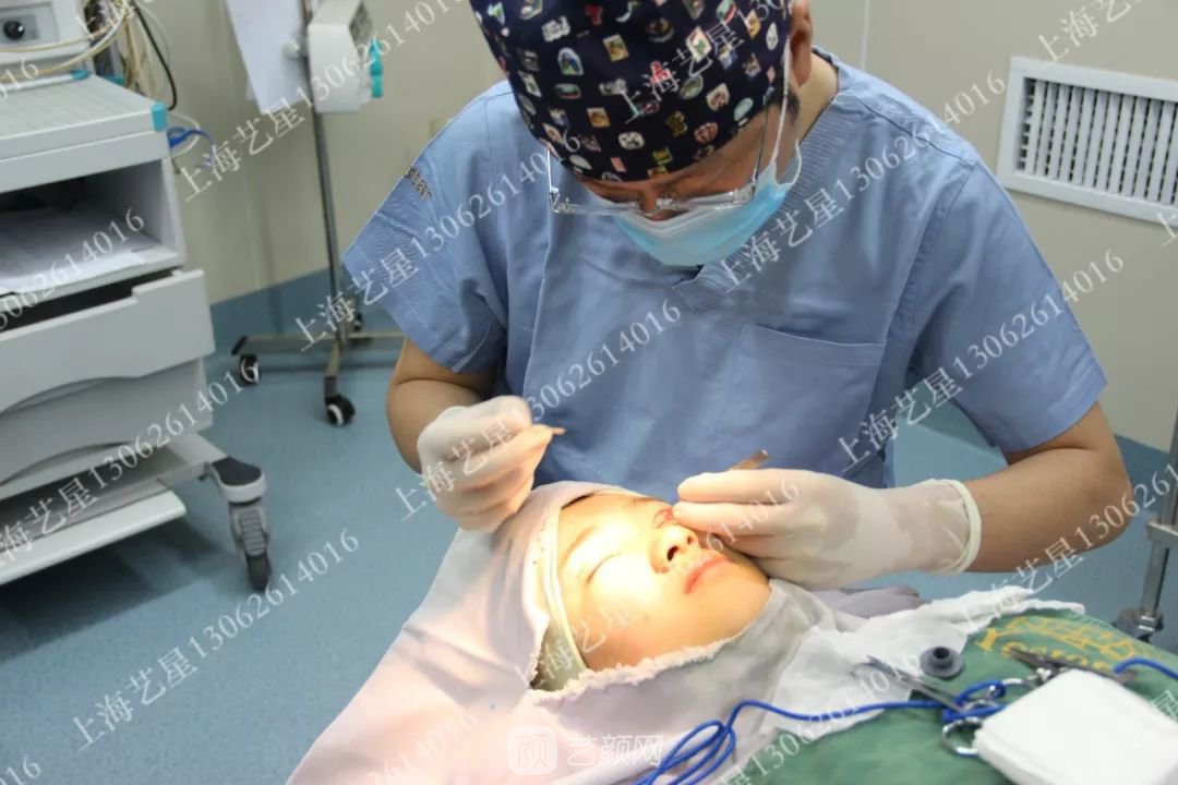 上海藝星割雙眼皮術(shù)后一個(gè)月恢復(fù)日記一則~