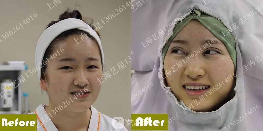 上海藝星割雙眼皮術(shù)后一個(gè)月恢復(fù)日記一則~