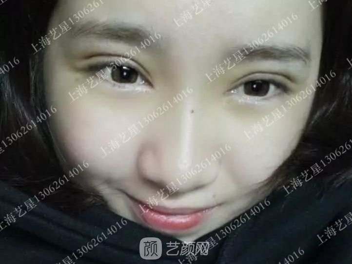 上海藝星割雙眼皮術(shù)后一個(gè)月恢復(fù)日記一則~