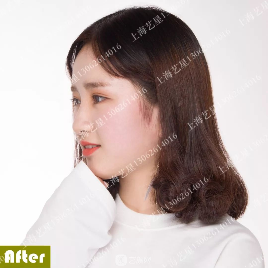 上海藝星割雙眼皮術(shù)后一個(gè)月恢復(fù)日記一則~