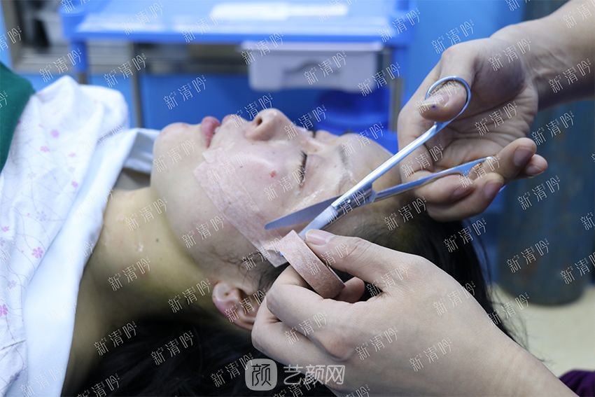 杭州新清吟陳永自體脂肪面部填充+注射瘦臉除皺案例直播~