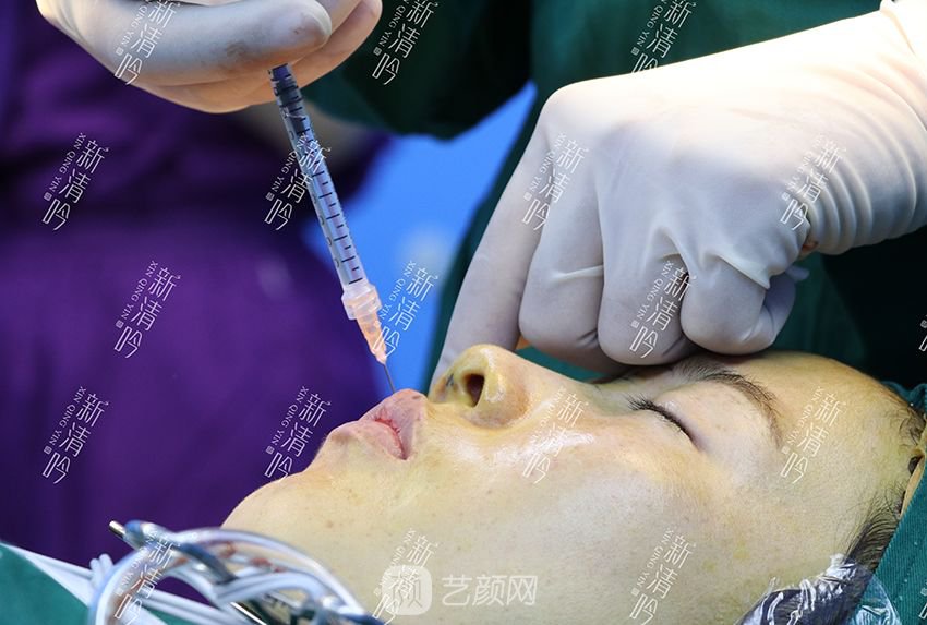 耳軟骨隆鼻果圖分享，術(shù)后~