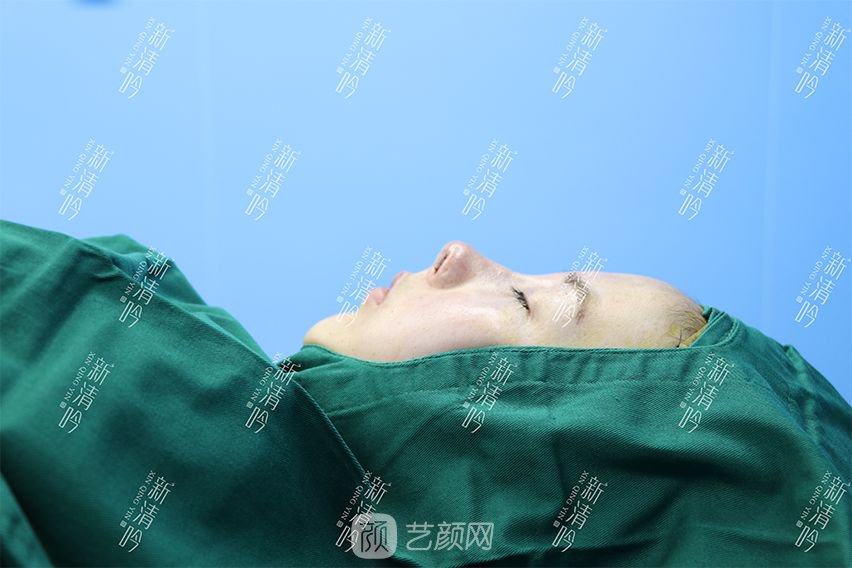 耳軟骨隆鼻果圖分享，術(shù)后~