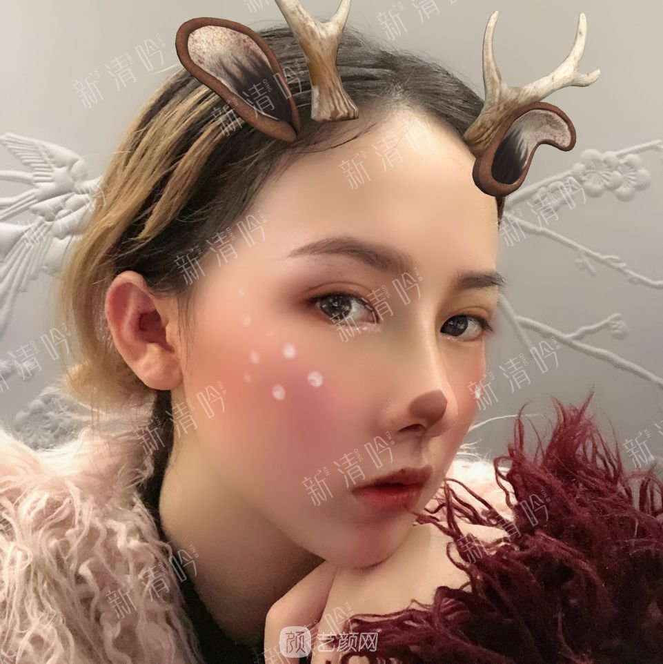 耳軟骨綜合隆鼻半個月了，分享恢復果照片~